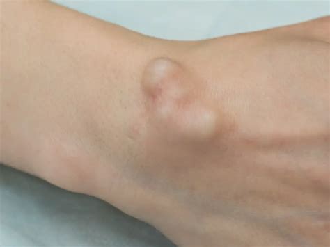 Ganglion Cyst | Carpal Tunnel Surgery Clinic