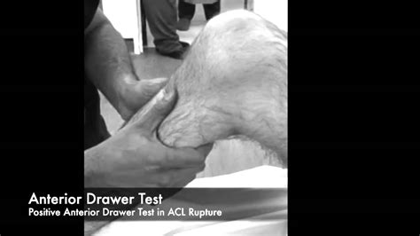 Anterior Drawer Test