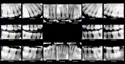 Dental X Rays Cut Mouth at Jamie Harris blog