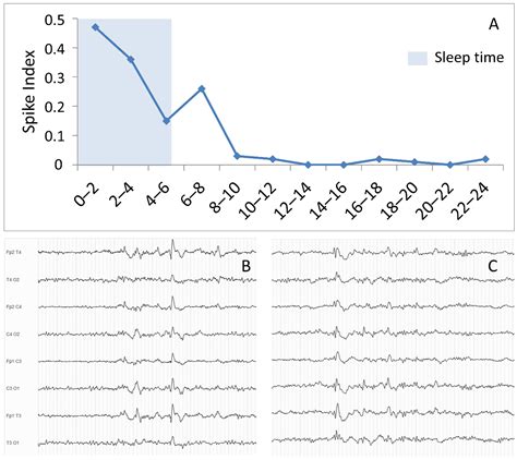 Biomedicines | Free Full-Text | EEG Markers of Treatment Resistance in ...