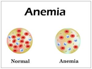 Anemias causes, symptoms, features, diagnosis & Types of Polycythemia | Science online