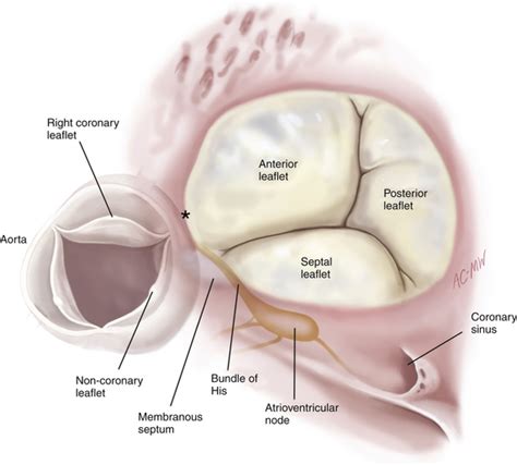 Tricuspid Valvular Disease | Thoracic Key