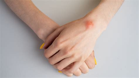 Ganglion Cyst Of The Wrist: How Do I Know If I Have One?, 48% OFF