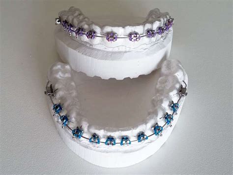 Clear Retainer with Brackets | Fake Braces | BracesShop.com