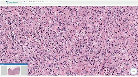 Malakoplakia - Histopathology - YouTube