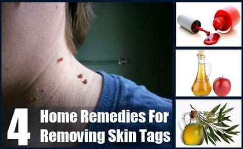 4 Home Remedies For Removing Skin Tags - How To Remove Skin Tags ...