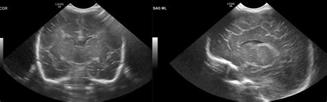 Cranial Ultrasound | UAMS Department of Radiology