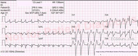 Atrial Fib To Cardiac Arrest | ECG Guru - Instructor Resources