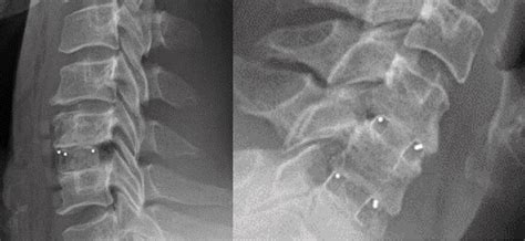 Cervical and Intervertebral Cage I icotec Cervical Cage