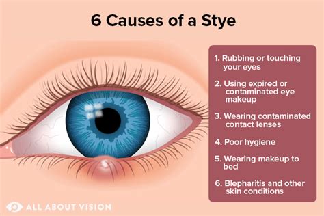 What Causes a Stye? - All About Vision