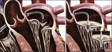 MitraClip™ - Center for Advanced Cardiac and Vascular Interventions