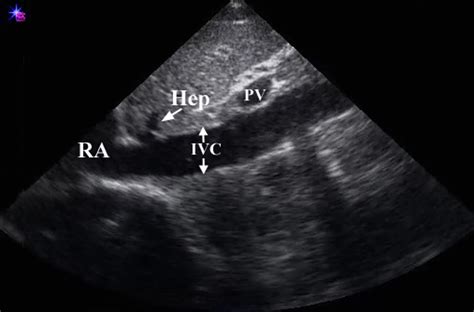 IVC Images | Emergency Ultrasonography