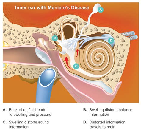 Meniere's disease - causes, symptoms, treatments