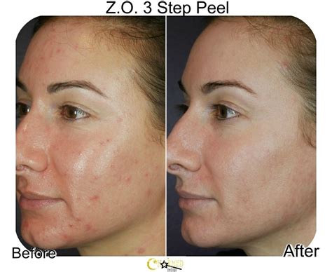 Chemical Peel At Home For Face, Neck and Chest – Charmed Medispa