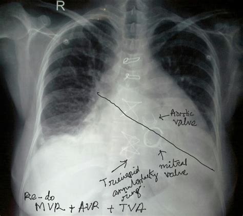 Aortic Valve Stenosis X Ray