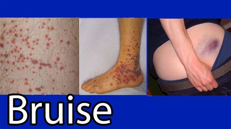 Bruise, Hematoma, blue spots on skin. causes and treatment - YouTube