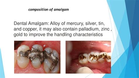 amalgam restoration