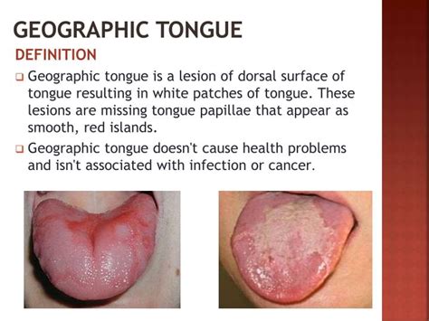 PPT - TONGUE DISORDERS PowerPoint Presentation - ID:1947046