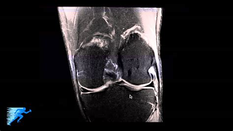 Comandante es inutil Peticionario knee axial mri anatomy ventaja ganador Continuación