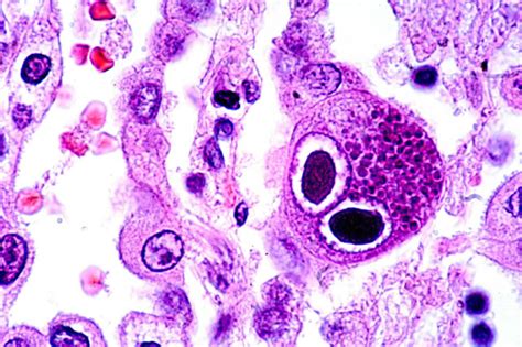 Cytomegalovirus (CMV) infection nuclear inclusions | Medical Laboratories