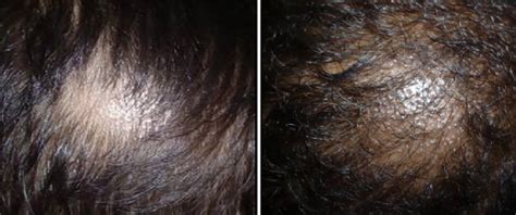 Tinea capitis showing circular lesions with black dot alopecia ...