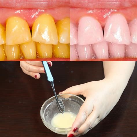 How To Whiten Your Teeth Naturally At Home Quickly & Instantly – My Simple Remedies