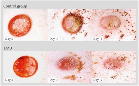 Granulation Tissue Wound Healing Stages - vrogue.co