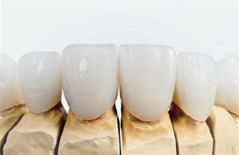 Tooth Discoloration Types : Dental Implants