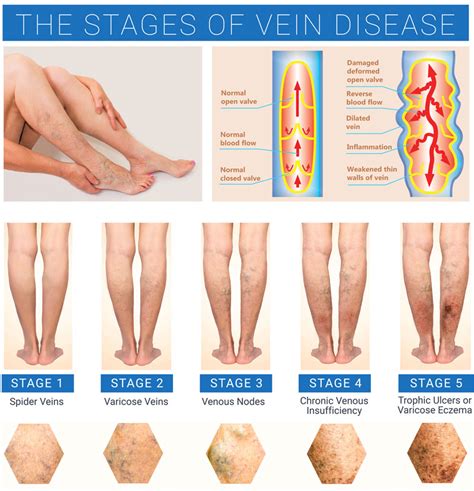 Varicose Veins Treatment | Vein Institute Of Pinellas [Free Consultation]