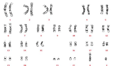 Y Chromosome Karyotype