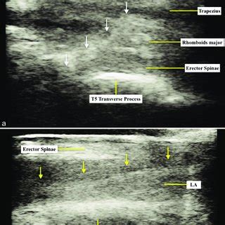 Continuous Serratus Anterior Plane Block. Ultrasound image of catheter ...