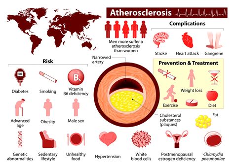 UPG: Arteriosclerosis and Marijuana; Treat Arteriosclerosis With Cannabis!