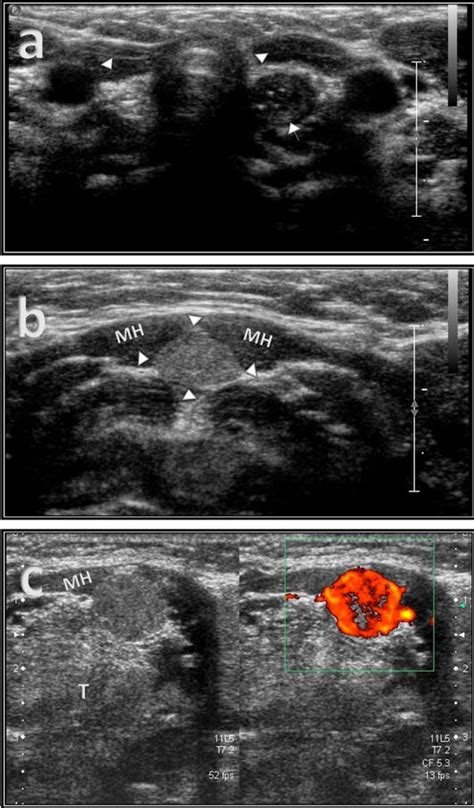 Enlarged Thyroid Ultrasound Image