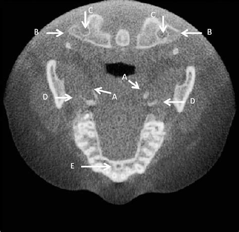 Mental foramen right, mental foramen left in the axial view. Figure 4 ...