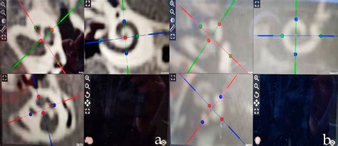 Figure 1 from Intra- and Interrater Reliability of CT- versus MRI-Based ...