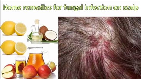 Details 80+ fungal infection on hair scalp best - in.eteachers