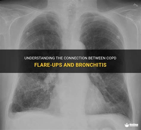 Understanding The Connection Between Copd Flare-Ups And Bronchitis ...