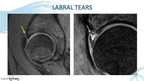 Hip Labrum Mri Anatomy