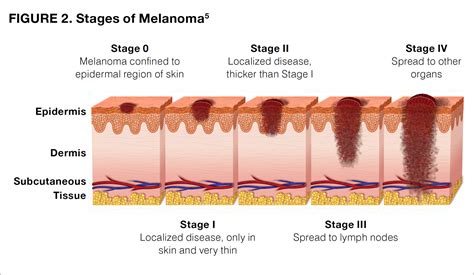 Melanoma pictures by stages, stage 0-1-2-3-4 melanoma pictures, melanoma in situ picture ...