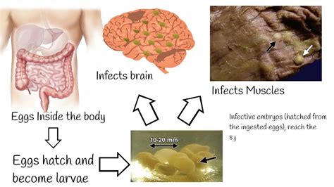 Neurocisticcircosis symptoms and treatment. Why is pork tapeworm so dangerous? - YouTube