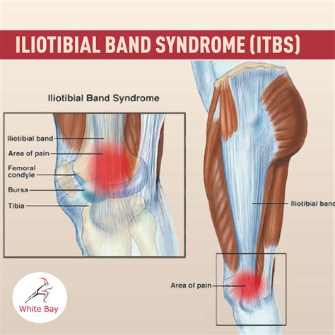 Iliotibial Band Syndrome Knee