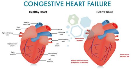 Cardiopoietic Stem Cell Therapy Congestive Heart Failure [CHF]