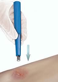 Biopsy - Dr Steve Edwards