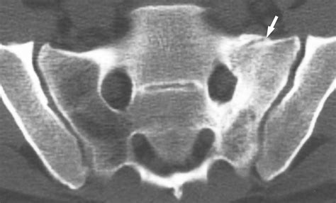 Fractured Sacrum - Fracture Treatment