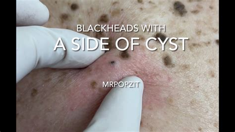 Blackheads with a side of cyst.Blackhead extractions and cyst excision with closure.Cyst ...