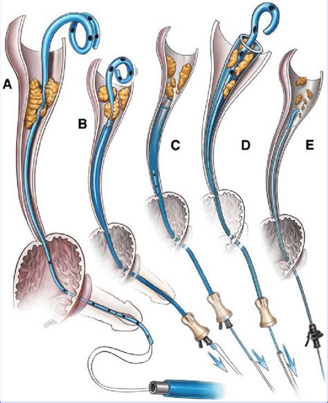 Telescopic access sheath method of removing an encrusted ureteral... | Download Scientific Diagram