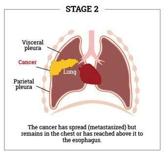 Mesothelioma: What are it's Causes, Symptoms & Prognosis? Learn more | MesotheliomaHelp.org