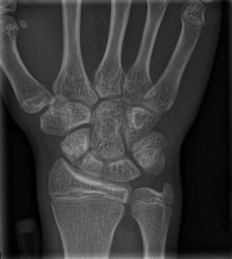 Radiograph of the left wrist shows stress fracture of the left scaphoid ...