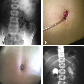 (PDF) Laparoendoscopic single-site surgery (LESS) for treatment of different urologic ...