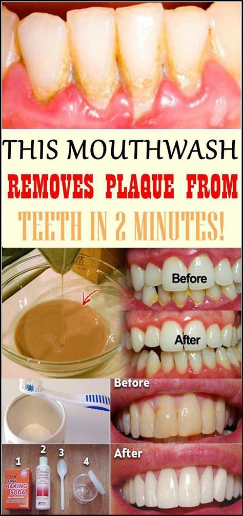 THIS MOUTHWASH REMOVES PLAQUE FROM TEETH IN 2 MINUTES in 2020 ...